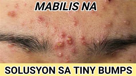 Paano Maalis Ang Tiny Bumps Or Butlig Butlig Sa Mukha Youtube