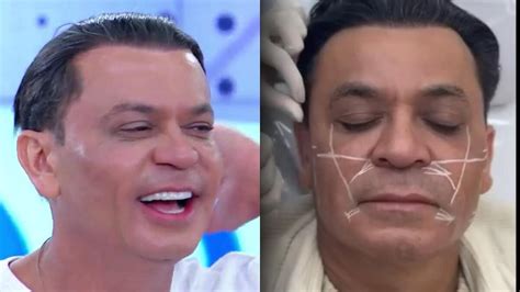 Frank Aguiar surpreende nova harmonização facial