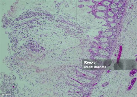 Pseudomembranous Colitis Stock Photo - Download Image Now - Anatomy ...