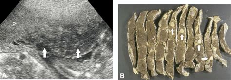 Placental Infarcts A Sagittal Grayscale Image Shows Multiple Download Scientific Diagram