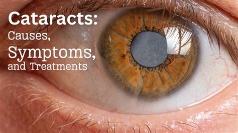 Understanding Cataracts Causes Symptoms And Treatments Youtube