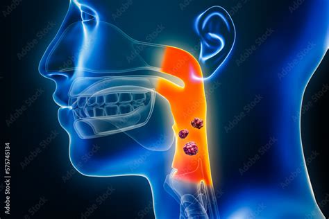 Pharyngeal Or Throat Cancer With Organs And Tumors Or Cancerous Cells