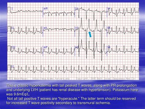 Electrolytes Imbalance And Ecg Changes Presentation