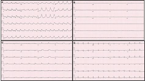 Myocarditis Ecg Changes