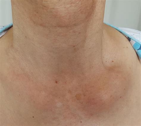 Collection 98 Pictures Pictures Of Swollen Collar Bone Updated