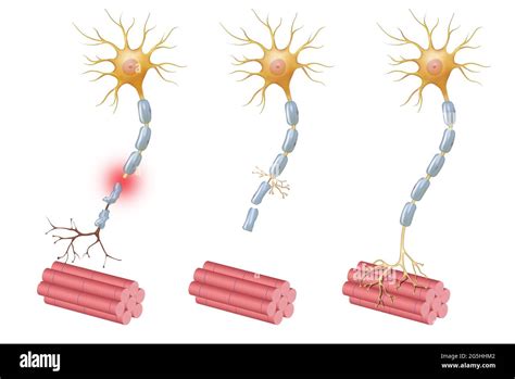 Neuroregeneration Refers To The Regrowth Or Repair Of Nervous Tissues