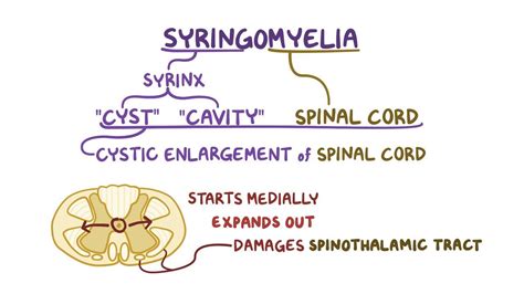 Syringomyelia: Video, Anatomy, Definition & Function | Osmosis