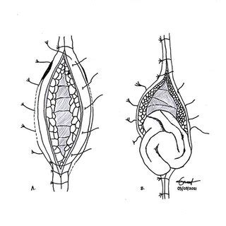 A Case Of 35 Year Old Woman With Incisional Hernia Post Laparatomy