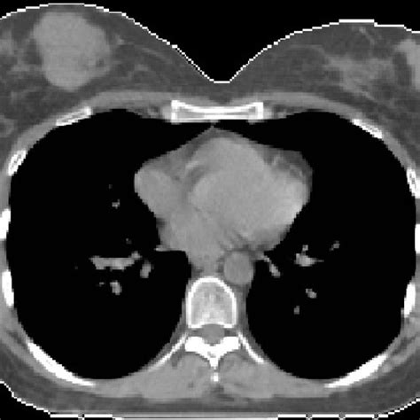 Axial Computed Tomography Images Of The Patient Showing Bilateral