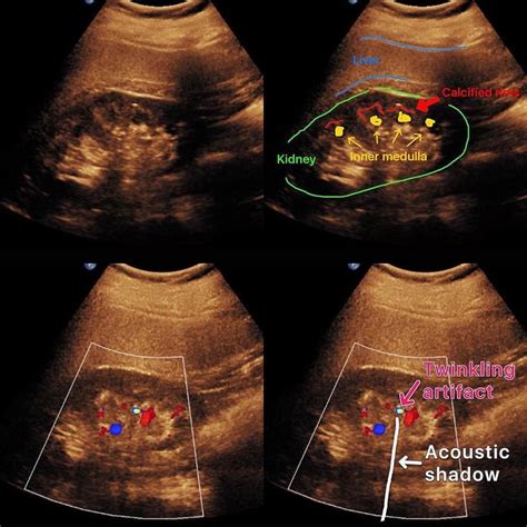 Early Nephrocalcinosis And Nephrolithiasis In A Patient With Idiopathic Hypercalciuria