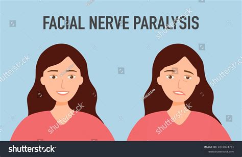 Face Palsy Images Stock Photos Vectors Shutterstock