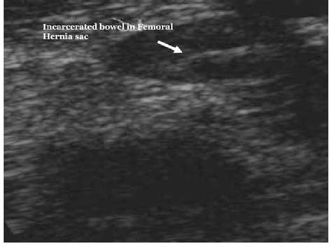 Preoperative Ultrasound Of The Groin Download Scientific Diagram