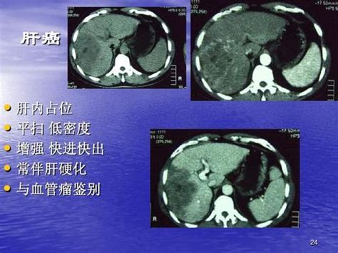 做了普通ct，为什么还要再做一个增强ct，两者有什么差别