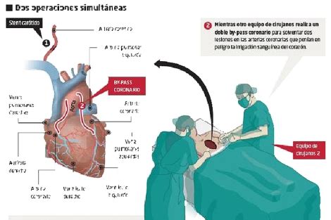 Una Operaci N Pionera Resuelve Lesiones Coronarias Y Vasculares