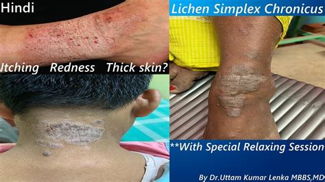 Lichen Simplex Chronicus Treatment Of Thickened Itchy Skindry Eczema