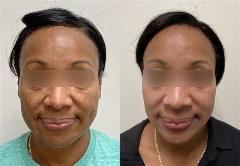 Chemical Peel Near Me Black Owned Jin Louis