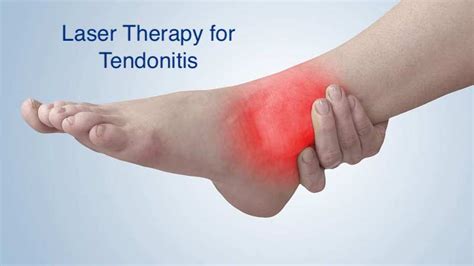 Why Laser Therapy Is The Best Way To Treat The Tendonitis Domer Laser