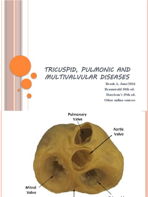 Tricuspid Pulmonic And Mixed Valve Disorders Pdf Heart Valve Heart