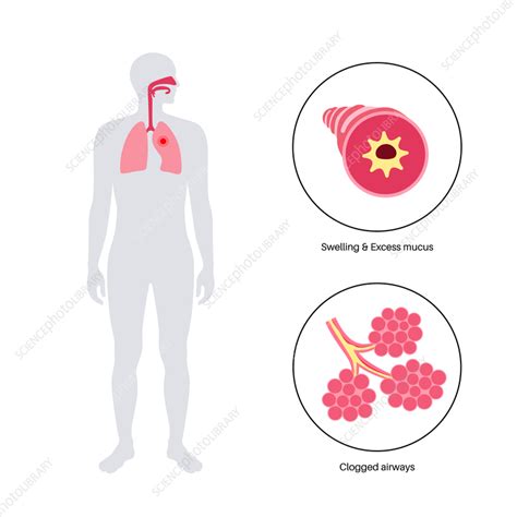 Bronchitis Lung Disease Illustration Stock Image F040 2787 Science Photo Library