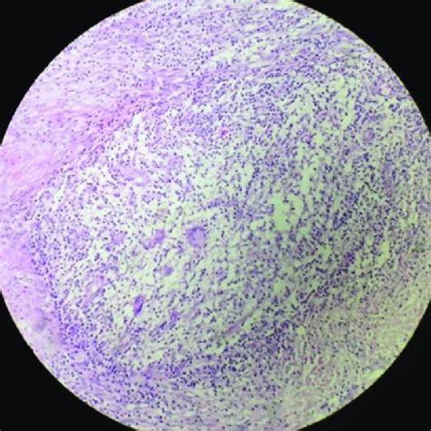 B Histopathological Examination Showing Granulomatous Reaction With