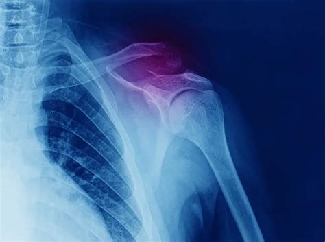 What To Do About A Dislocated Shoulder General Orthopedic Surgeons