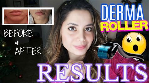 Derma Roller Before And After 😱 Unbelievable Results Youtube