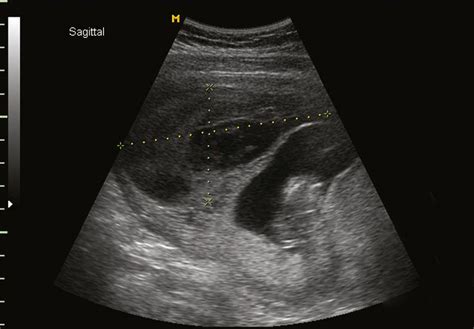 Antepartum And Postpartum Hemorrhage Clinical Tree