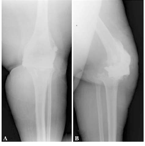 A B A Ap And B Lateral Radiographs Of The Knee Of A 65 Yearold Download Scientific Diagram