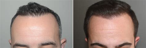 Forehead Reduction Surgery Hair Transplants For Men Photos Miami Fl