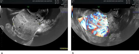 Acute And Repeated Haemoperitoneum A Challenging Case Of