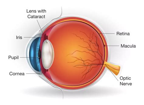 Cataract Eye Doctors