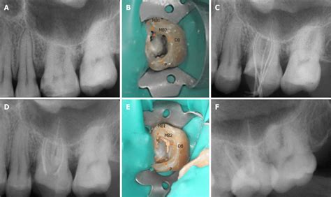 Clinical And X Ray Images Showing The Treatment Process A Download Scientific Diagram