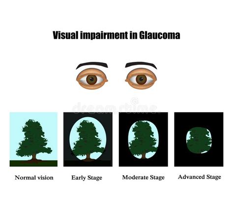 Comparative Information Between Healthy Eye And Glaucoma Eye Vector Illustration Stock Vector