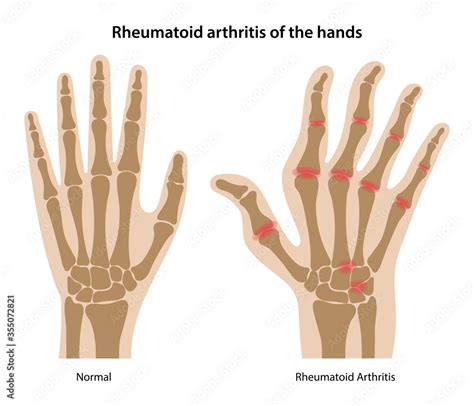 Rheumatoid arthritis of the human's hands. Silhouettes of healthy and ...