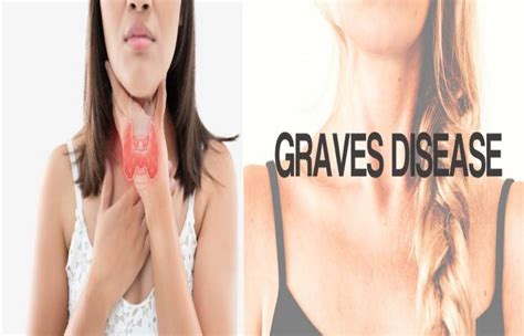 What Is Graves Disease Definition Symptoms Causes And More