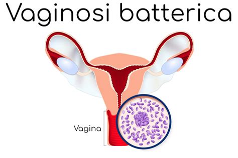 Vaginosi Batterica Sintomi Cura Rimedi E Prevenzione