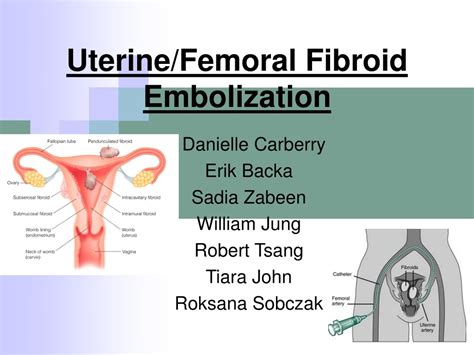 PPT Uterine Femoral Fibroid Embolization PowerPoint Presentation