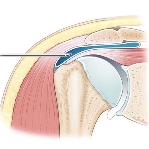 Subacromial Injection Subacromial Shoulder Injection Ultrasound