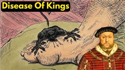 Horrific History Of Gout The Disease Of Kings Youtube