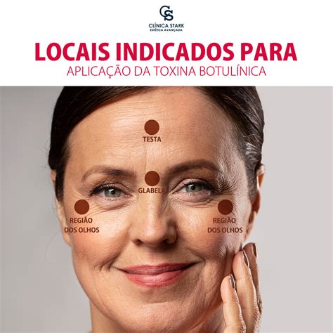 Lista Foto Botox Para Bruxismo Antes Y Despues Actualizar