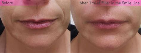 Fillers For Smile Lines Cheek And Jowl Salt Lake City Botox And Fillers