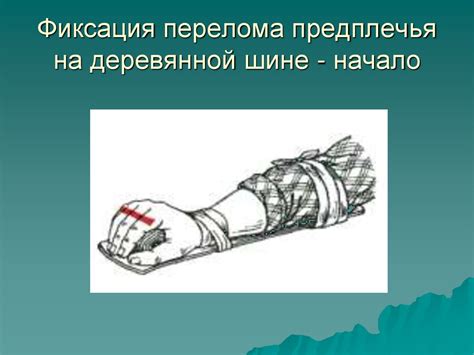 Оказание первой медицинской помощи при ушибах, переломах - презентация ...