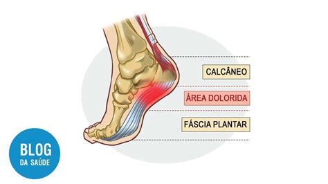 Fascite Plantar O Que Causas Sintomas E Tratamentos Blog Da Sa De