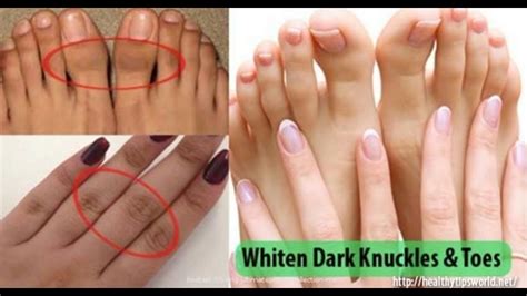 THIS IS HOW YOU CAN GET RID OF DARK KNUCKLES AND TOES EASILY AT HOME