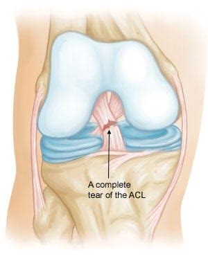 Ruptura De Ligament Incrucisat Anterior Dr Ion Bogdan Codorean