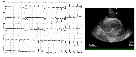 Electrical Alternans Article