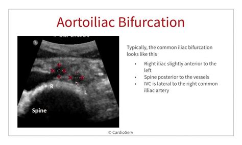 Abdominal Ultrasound for Echocardiographers: Aorta and IVC Cardioserv