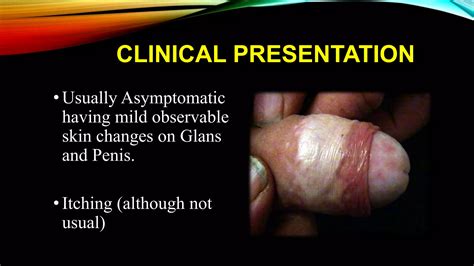 Balanitis Xerotica Obliterans Bxo Penile Lichen Sclerosis Ppt