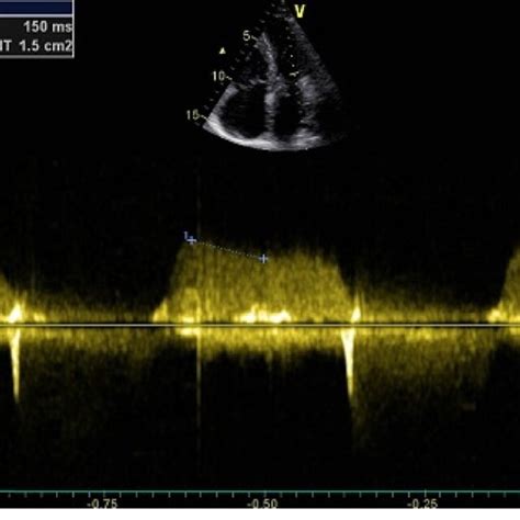 Continuous Wave Doppler Showing Moderate Mitral Stenosis And Severe