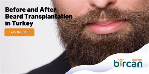 Before And After Beard Transplantation In Turkey Dr Gökhan Bircan